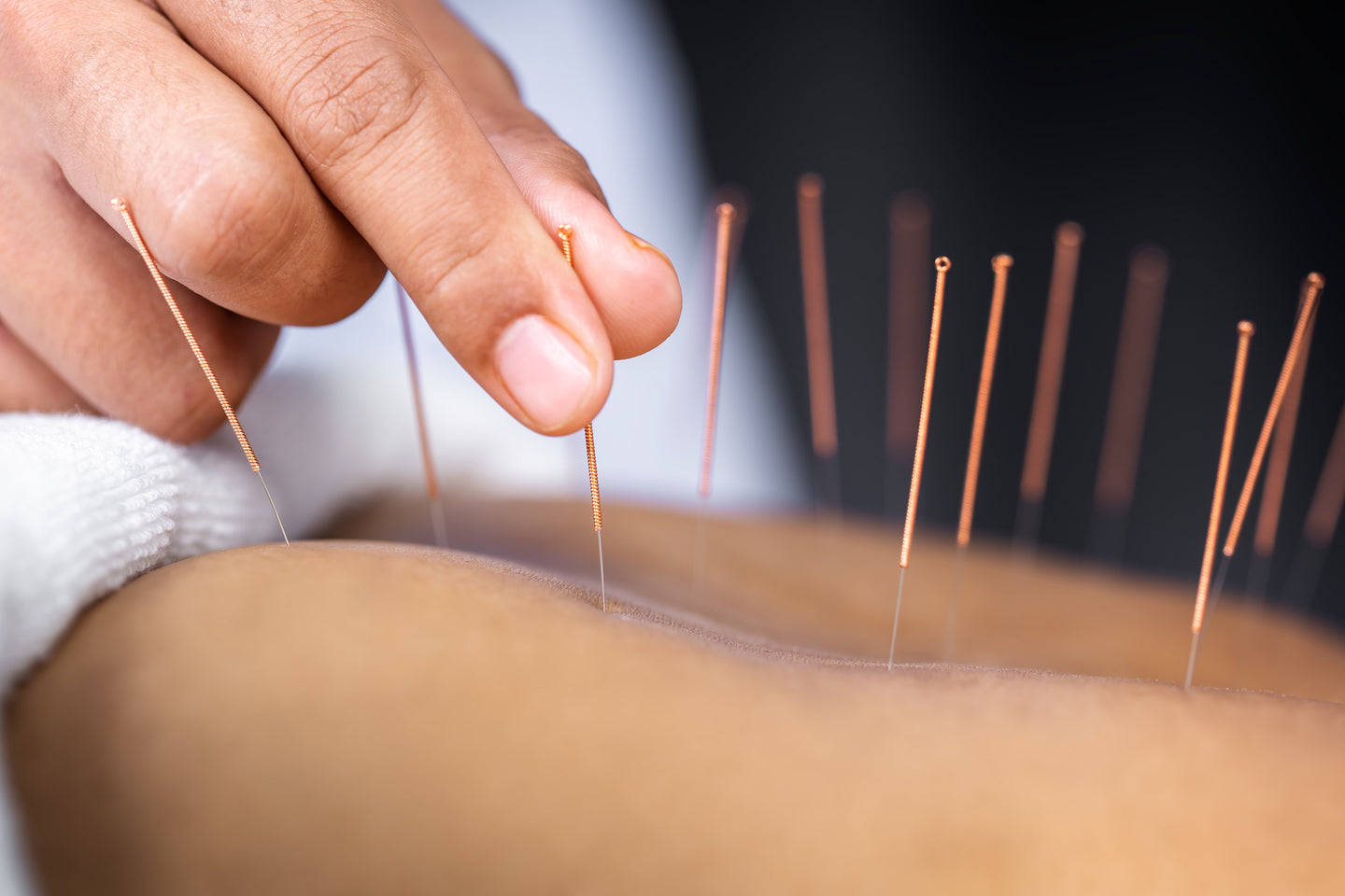 Naturlig behandling med akupunktur uden bivirkninger