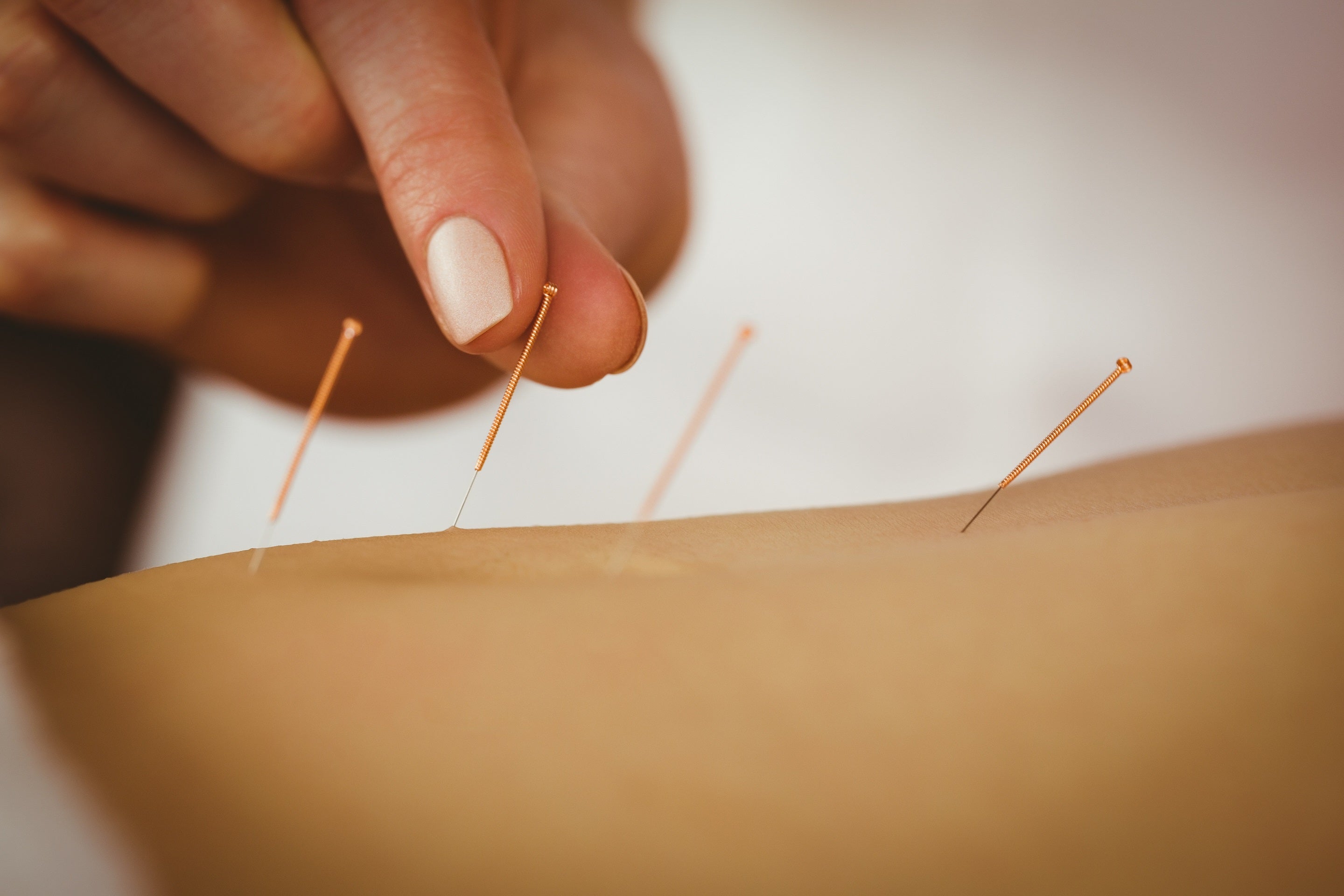 Klassisk akupunkturbehandling hos WE Clinic